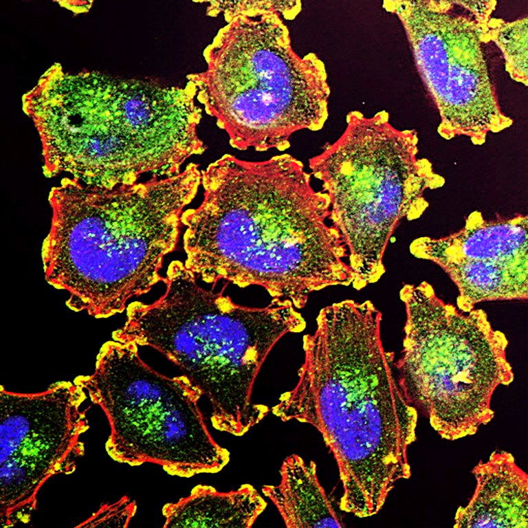 Kandaki T hücreleri İle Kanser Tedavisi